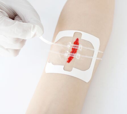 Disposable Emergency wound Closure strips,Pu film strips Can Close The 3cm WoundZip Stitch Wound Closures Device